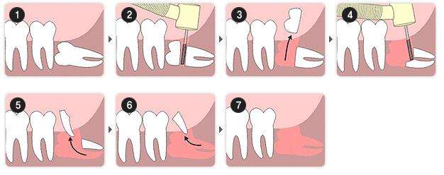 拔智齒痛多久？百度指數(shù)：15289 (拔智齒痛多久恢復(fù)正常)